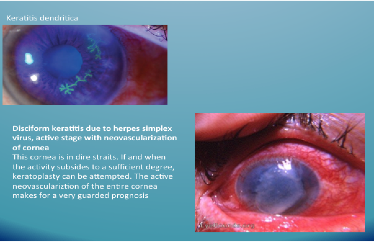 Abbildung Keratitis